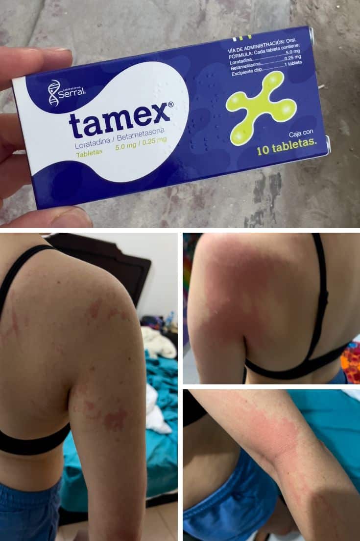 Hives from Mosquito bites received at Playa Punta Cocos
